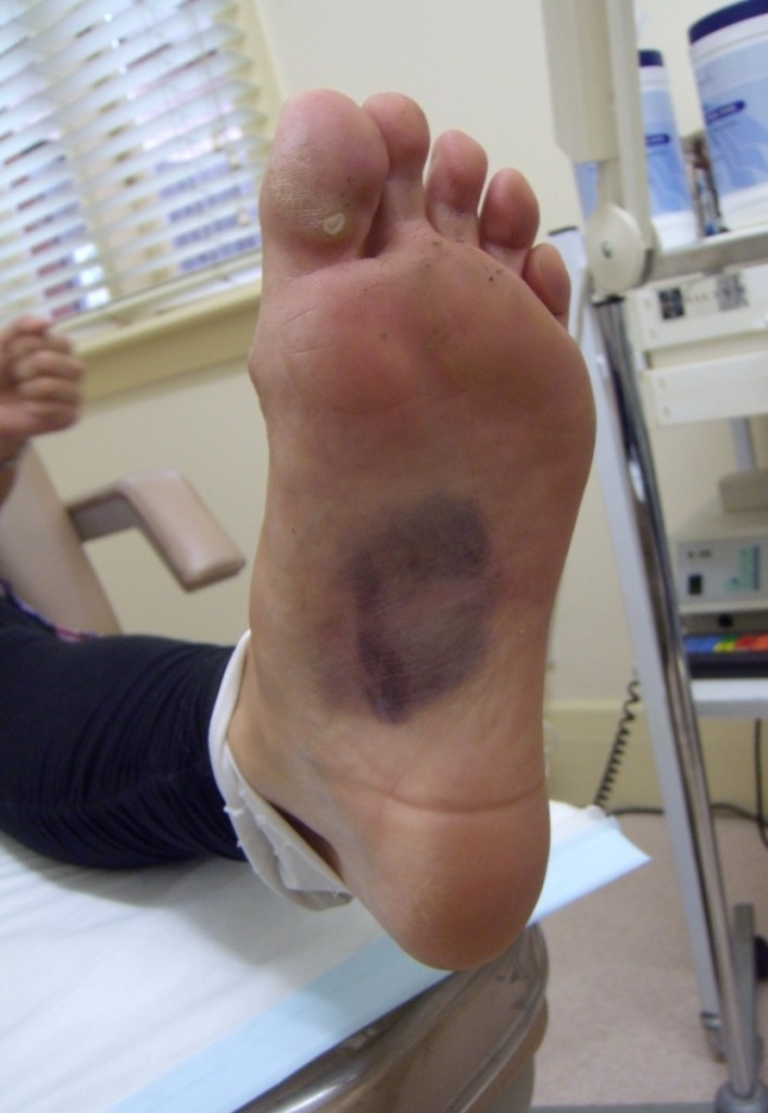 Bruised foot being examined by our sports podiatrist in Essendon